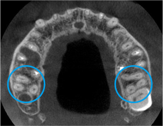 根の先の形態を3次元的に把握する歯科用CT診断の応用