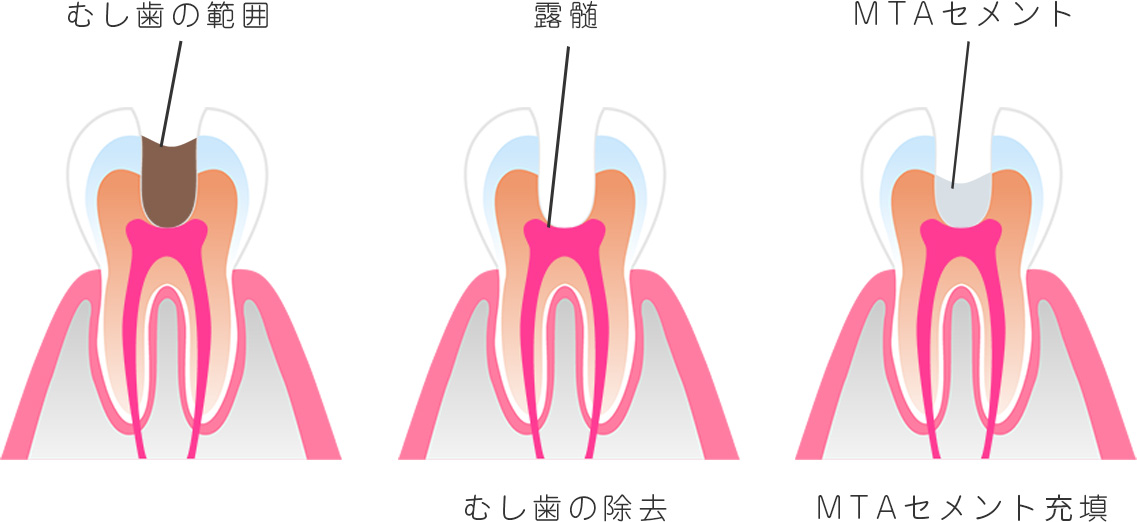 むし歯の除去